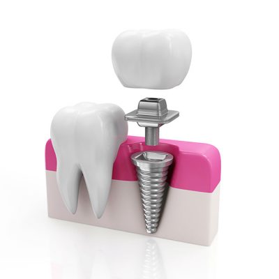 Implantes dentales Vitoria