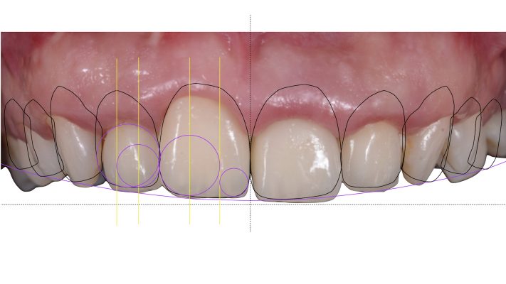 Prótesis dental