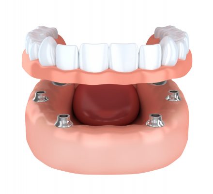 Prótesis sobre implantes