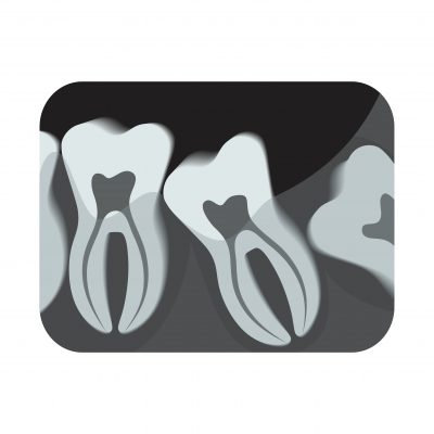 Radiografías dentales 2D