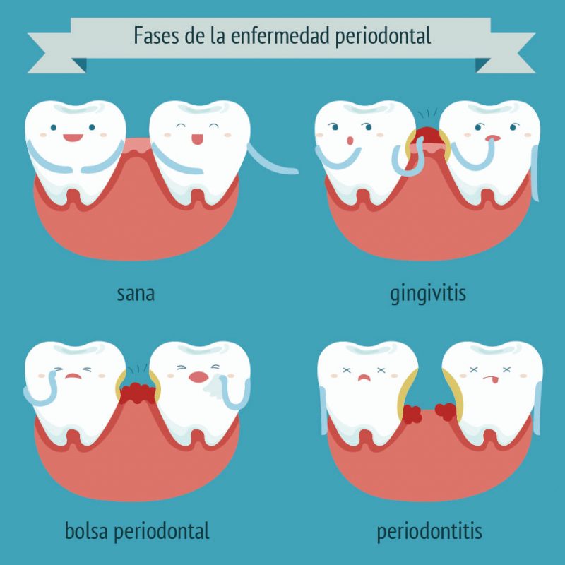 Periodontitis tratamiento