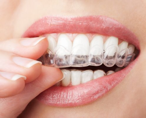 Ortodoncia invisible invisalign